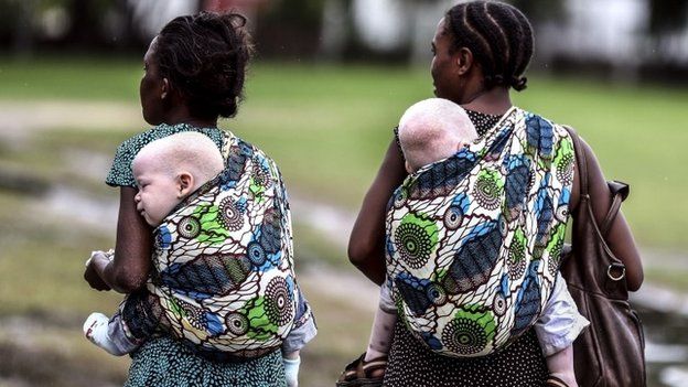 This image courtesy of the Milliyet Daily shows women carrying their albino children on 5 May 2014, in Dar es Salaam, Tanzania