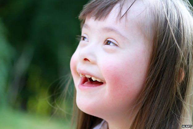 Girl with Downs' syndrome