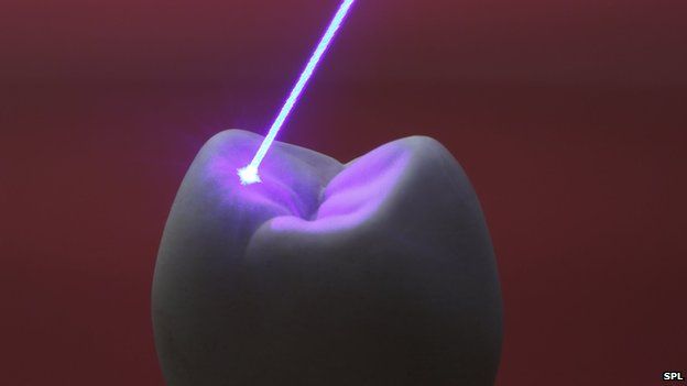 Laser fired at a tooth