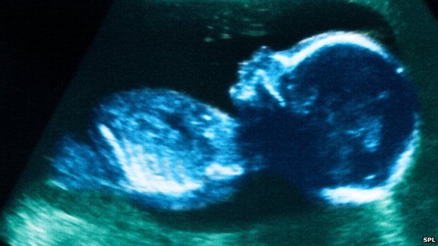 Ultrasound scan of baby in the womb