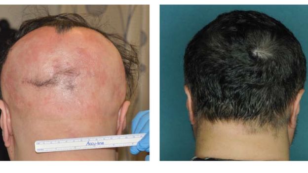 Alopecia can lead to patchy or complete hair-loss