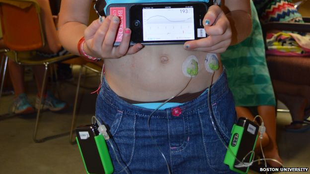 Young diabetic patient Elise Cunha shows off the bionic pancreas she is testing out.