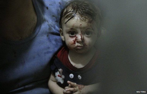 Child injured by what activists say were two air strikes in the north-eastern Damascus suburb of Douma (3 August 2014)