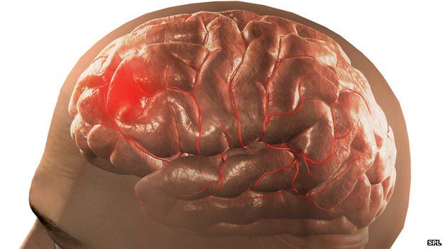 A blood clot on the brain