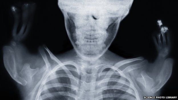 Thalidomide child x-ray
