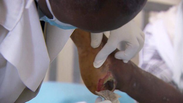 Dr Christopher Kibiwot removing a maggot bag from a patient