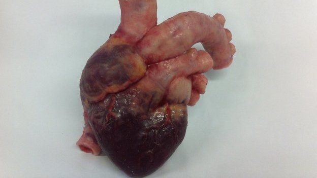 prosthetic heart