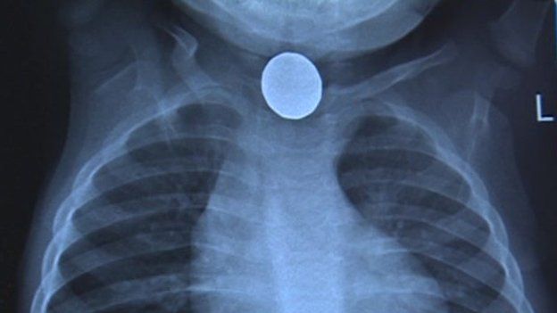X-ray of a battery lodged in a child's throat