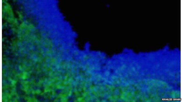 Toxin-producing stem cells (in blue) help kill brain tumour cells (in green).