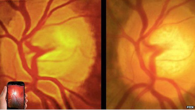 Two images of the retina