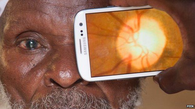 Patient's retina capture with Peek Retina