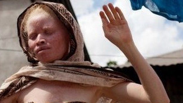 A Tanzanian albino hangs clothes to dry in front of her home in Dar es Salaam on 3 November 2010