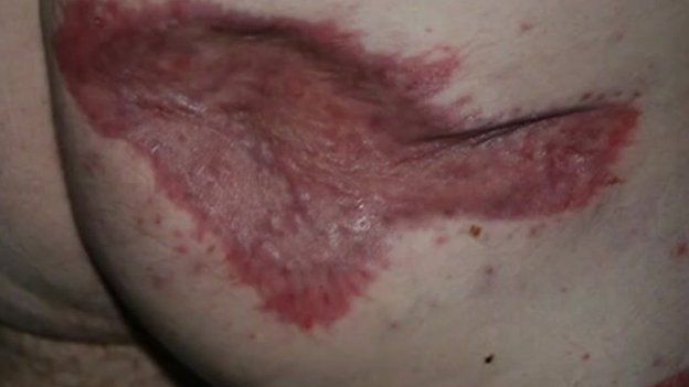 Maidstone Hospital fined £180,000 over mattress burns - BBC News