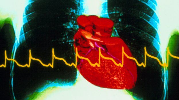 heart attack chest x-ray with ECG