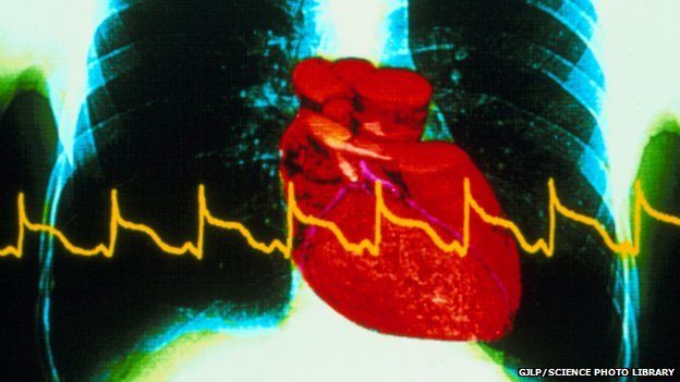 heart attack chest x-ray with ECG