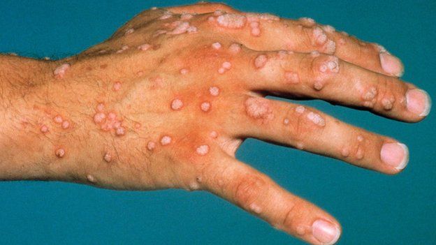 Hand covered in warts