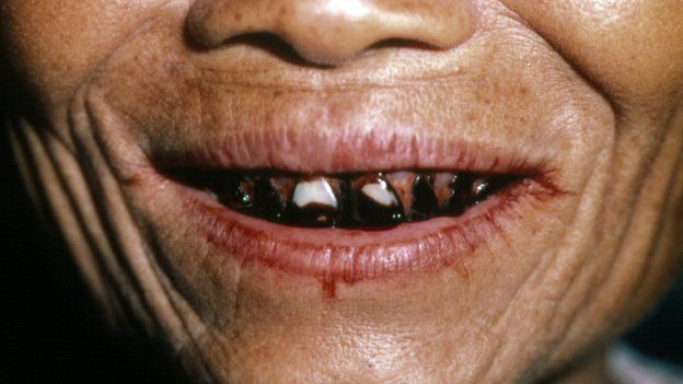 Betel chewer's teeth and lips