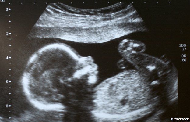 Scan of foetus