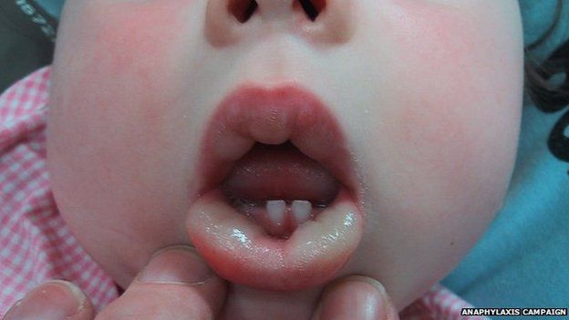 Picture of a baby with a swollen lip and flushed skin