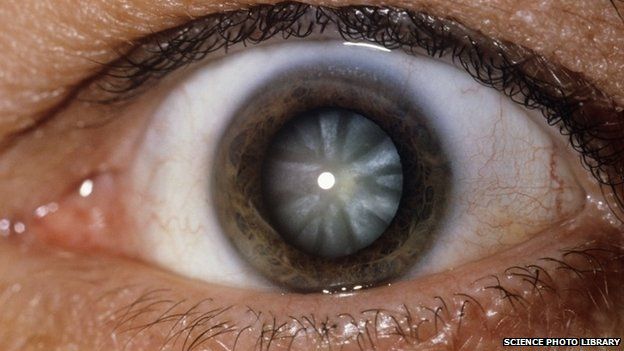 Close-up of the eye showing a cataract, an opacity in the lens of the eye that results in blurred vision