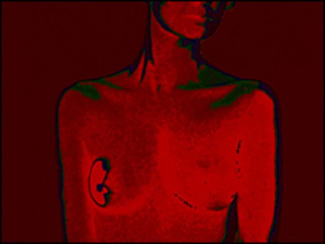 Tumor de mama