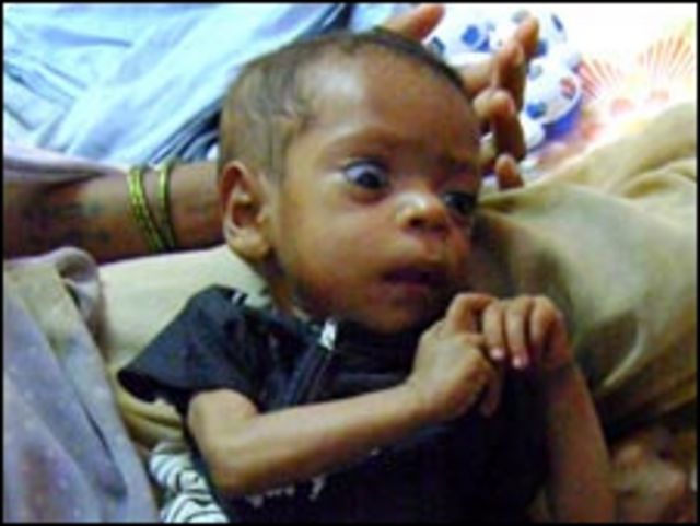 Niño desnutrido
