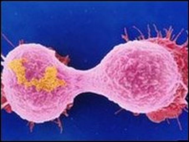 Célula cancerosa de mama
