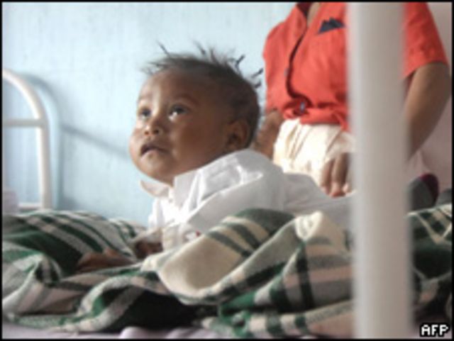 Niño desnutrido en un hospital de Jalapa, Guatemala