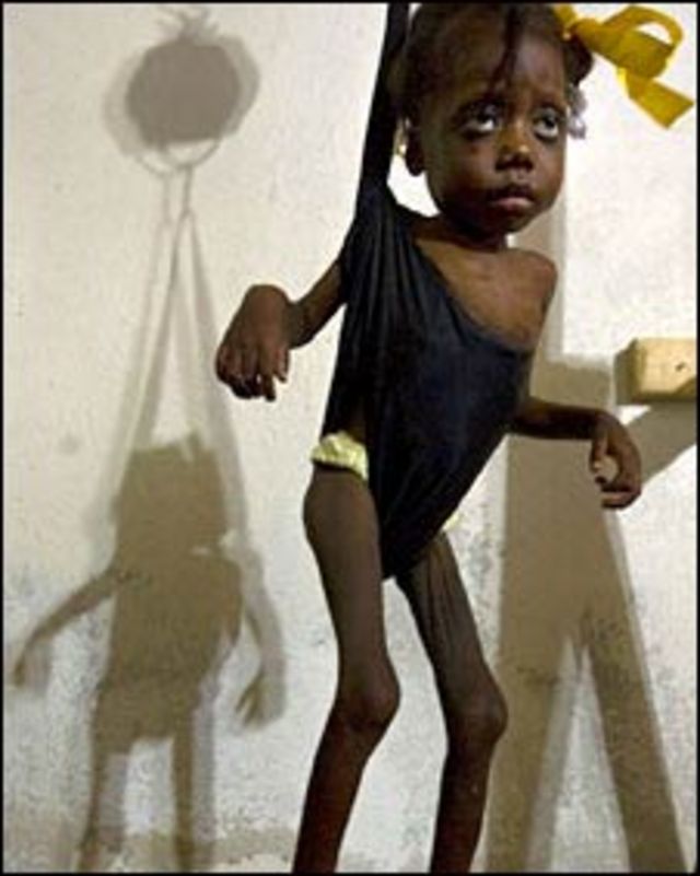 Niña malnutrida en Haití