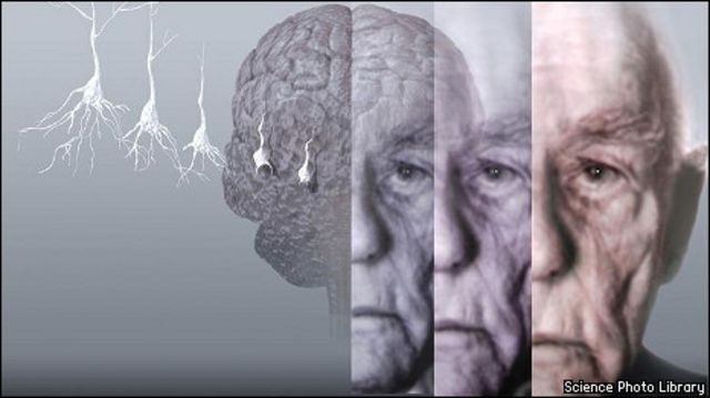 Tác động của việc ăn uống và lối sống không lành mạnh đến nguy cơ mắc bệnh Alzheimer?
