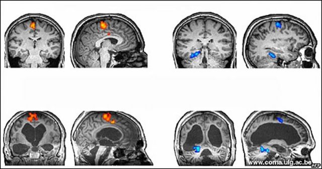 Imagen de un estudio sobre respuesta cerebral del Consejo de Investigación Médica, El Centro Wolfson de Imagen Cerebral de Cambridge (Reino Unido) y la Universidad de Lieja (Bélgica).