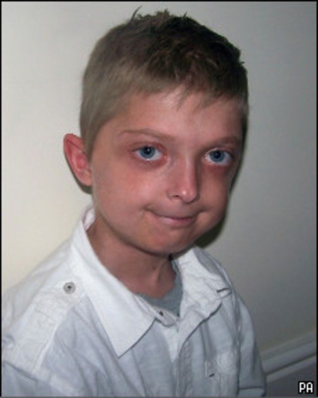 Doenca Rara Faz Menino De 11 Anos Envelhecer 5 Vezes Mais Rapido Bbc News Brasil