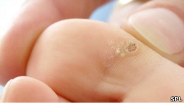 Virus del papiloma manos - Problema cu tratamentul viermilor