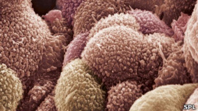 الاكتشاف المبكر لسرطان المبيض يزيد من معدلات الشفاء Bbc News عربي