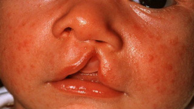 Arranca El Mayor Estudio Sobre La Causa Del Labio Leporino Bbc News Mundo