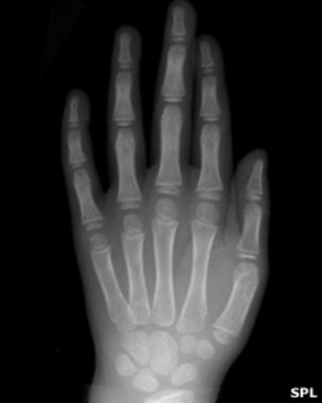 Рентгеновский снимок кисти руки