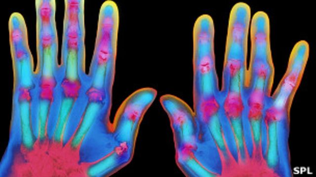 Decorativo Cambio Oxidado Realmente crujirse los dedos da artritis? - BBC News Mundo