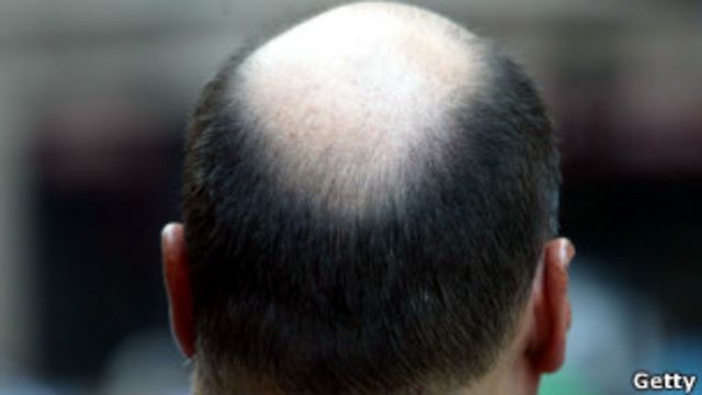 Por qué los calvos pierden primero el pelo de la coronilla? - BBC News Mundo