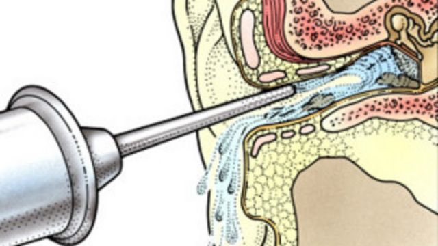 Polémico ojo Además Cinco cosas que quizás no sabe sobre la cera de los oídos - BBC News Mundo