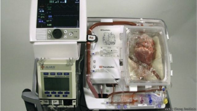 پیوند موفق اولین قلب مرده در جهان Bbc News فارسی