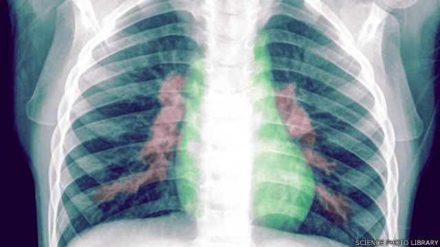 په سکاروي اخته ناروغان، ټوخی، تبه، او سالنډی لري، په عمومي توګه ناسازه وی، او که پر وخت ونه درملل شي وژونکې خړپړتیاوې ورسره ملګرې وي