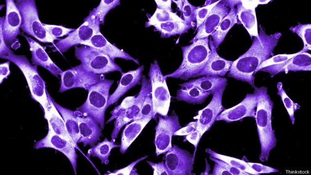 Melanoma