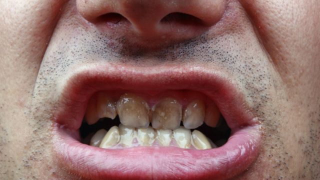 Tres Fantástico danés Los riesgos de blanquearse los dientes en casa o el salón de belleza - BBC  News Mundo