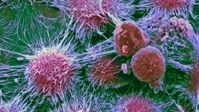 Razrabotano Effektivnoe Lekarstvo Protiv Raka Pochki Bbc News Russkaya Sluzhba