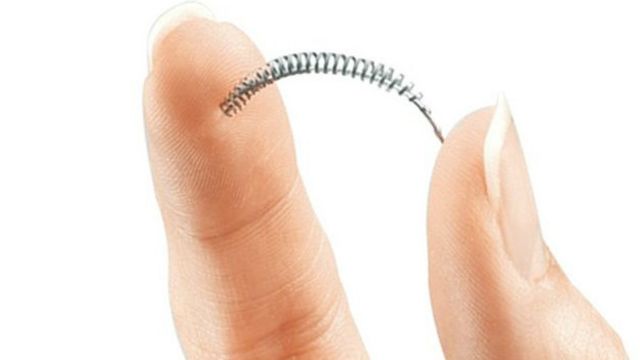 Essure: los del implante anticonceptivo "más seguro del mundo" - BBC News Mundo