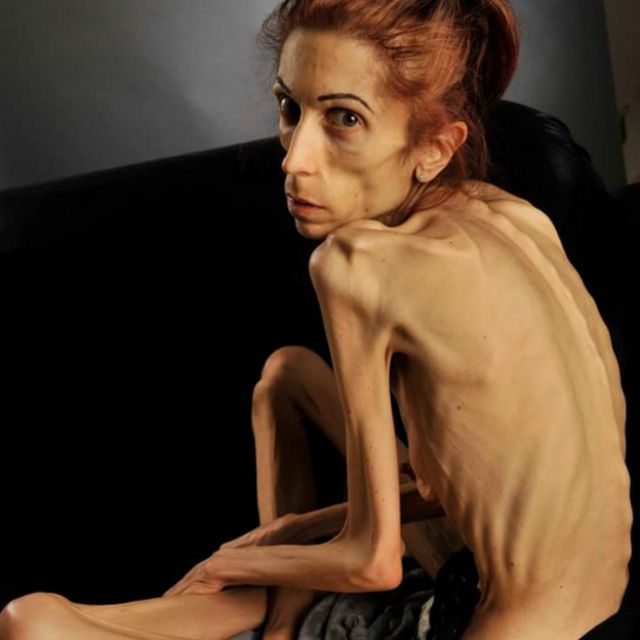 Americana que pesava 18 kg mostra recuperação de anorexia ba
