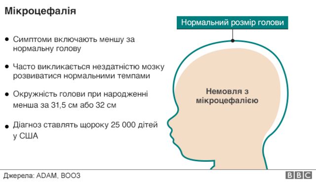 Мікроцефалія