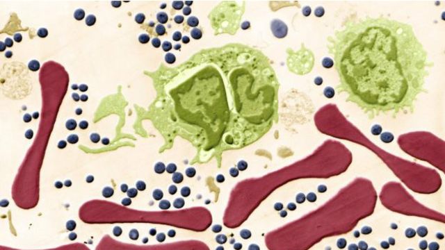 Que Es La Septicemia Por Que Mata Tanta Gente Y Es Tan Dificil De Detectar Bbc News Mundo