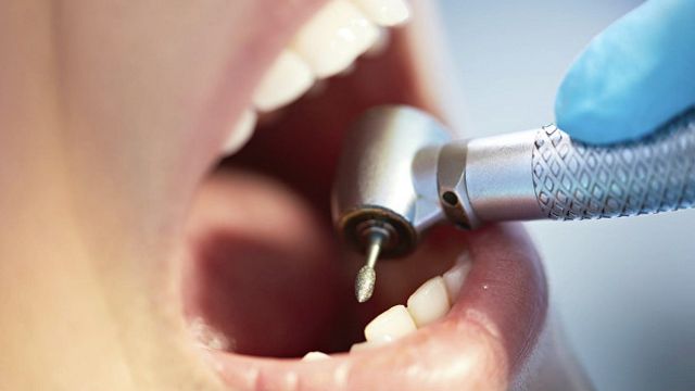 Почему стоматологи сверлят зубы перед пломбированием