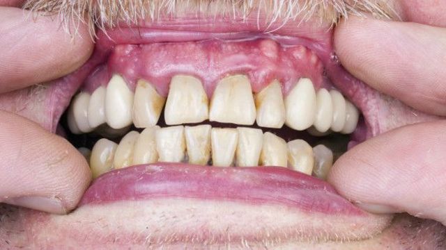 Желтые зубы у взрослых и детей: причины и методы лечения